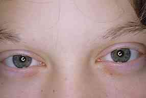 Les Causes de perte de Cils