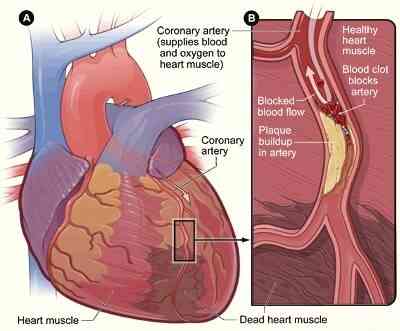 Combien De Temps Les Symptômes De Crise Cardiaque?