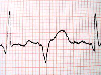 La Différence Entre un ÉLECTROCARDIOGRAMME, une Échocardiographie