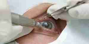La chirurgie de la cataracte de récupération—l