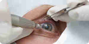 chirurgie des yeux au Laser